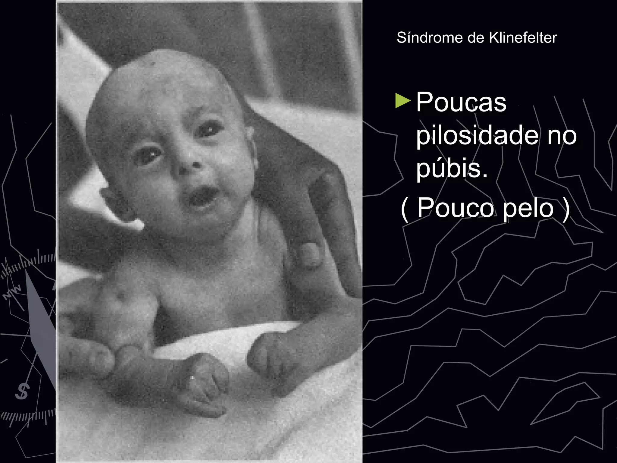 ►PoucasPoucas
pilosidade nopilosidade no
púbis.púbis.
( Pouco pelo )( Pouco pelo )
Síndrome de KlinefelterSíndrome de Klinefelter
 