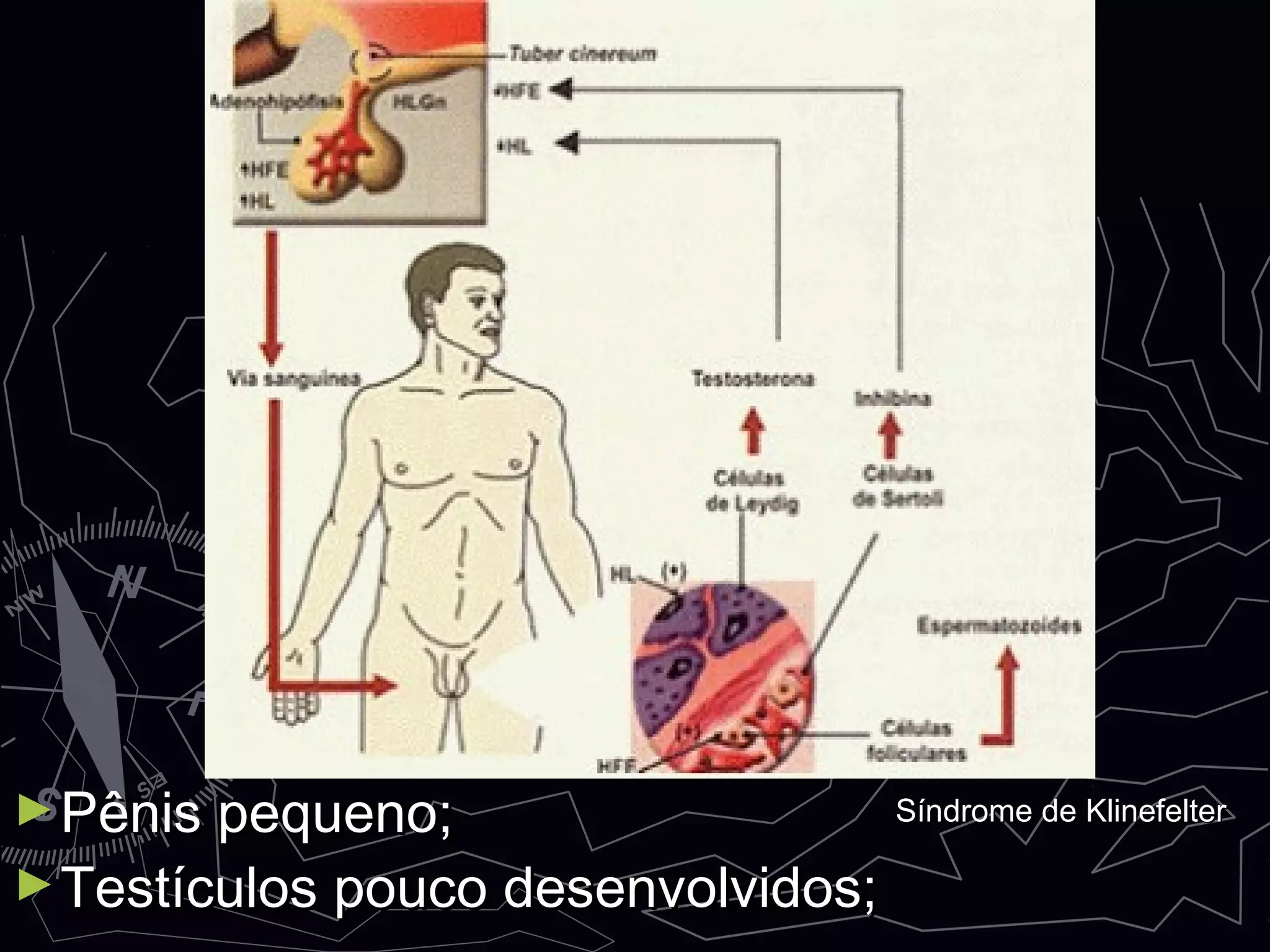 ►Pênis pequeno;Pênis pequeno;
►Testículos pouco desenvolvidos;Testículos pouco desenvolvidos;
Síndrome de KlinefelterSíndrome de Klinefelter
 