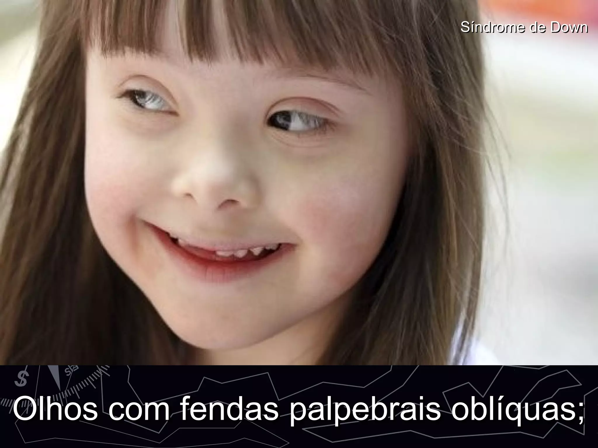 Olhos com fendas palpebrais oblíquas;Olhos com fendas palpebrais oblíquas;
Síndrome de DownSíndrome de Down
 