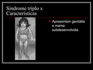  Apresentam genitália
e mama
subdesenvolvida.
Síndrome triplo x
Características
 