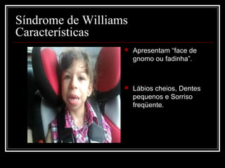 Síndrome de Williams
Características
 Apresentam “face de
gnomo ou fadinha”.
 Lábios cheios, Dentes
pequenos e Sorriso
freqüente.
 