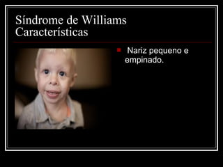  Nariz pequeno e
empinado.
Síndrome de Williams
Características
 