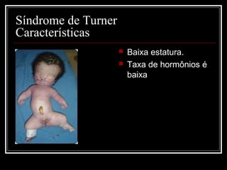  Baixa estatura.
 Taxa de hormônios é
baixa
Síndrome de Turner
Características
 