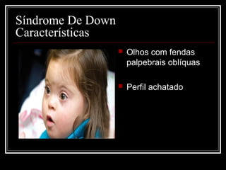 Síndrome De Down
Características
 Olhos com fendas
palpebrais oblíquas
 Perfil achatado
 