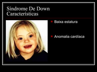  Baixa estatura
 Anomalia cardíaca
Síndrome De Down
Características
 