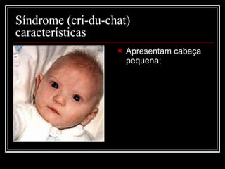  Apresentam cabeça
pequena;
Síndrome (cri-du-chat)
características
 