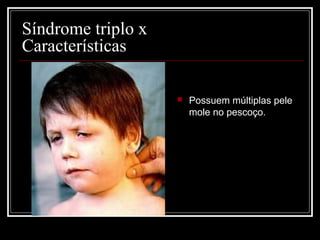 Síndrome triplo x
Características
 Possuem múltiplas pele
mole no pescoço.
 