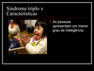  As pessoas
apresentam um menor
grau de inteligência.
Síndrome triplo x
Características
 