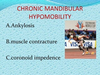 condyle disc-complex_derangement_1 | PPT