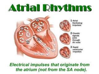 Atrial Rhythms ,[object Object]