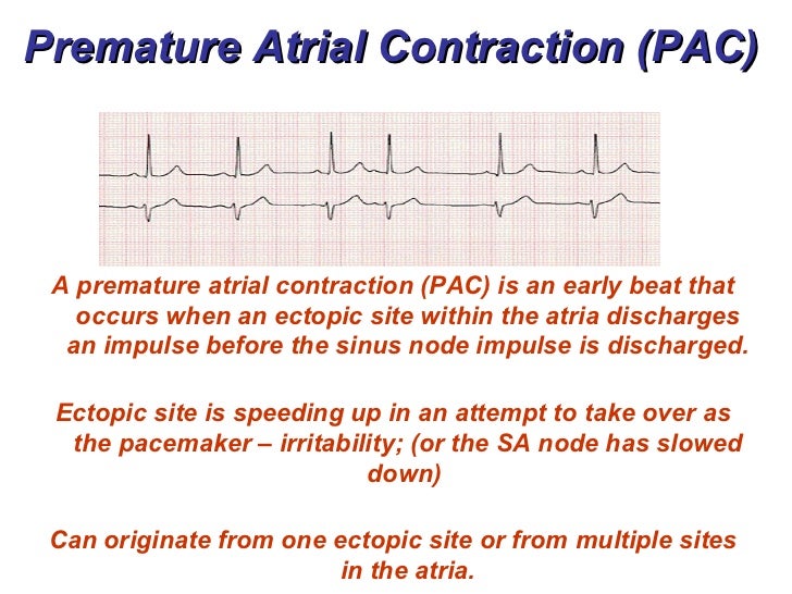 Atrial Rhythms Bmh Tele Atrial Rhythms Bmh Tele