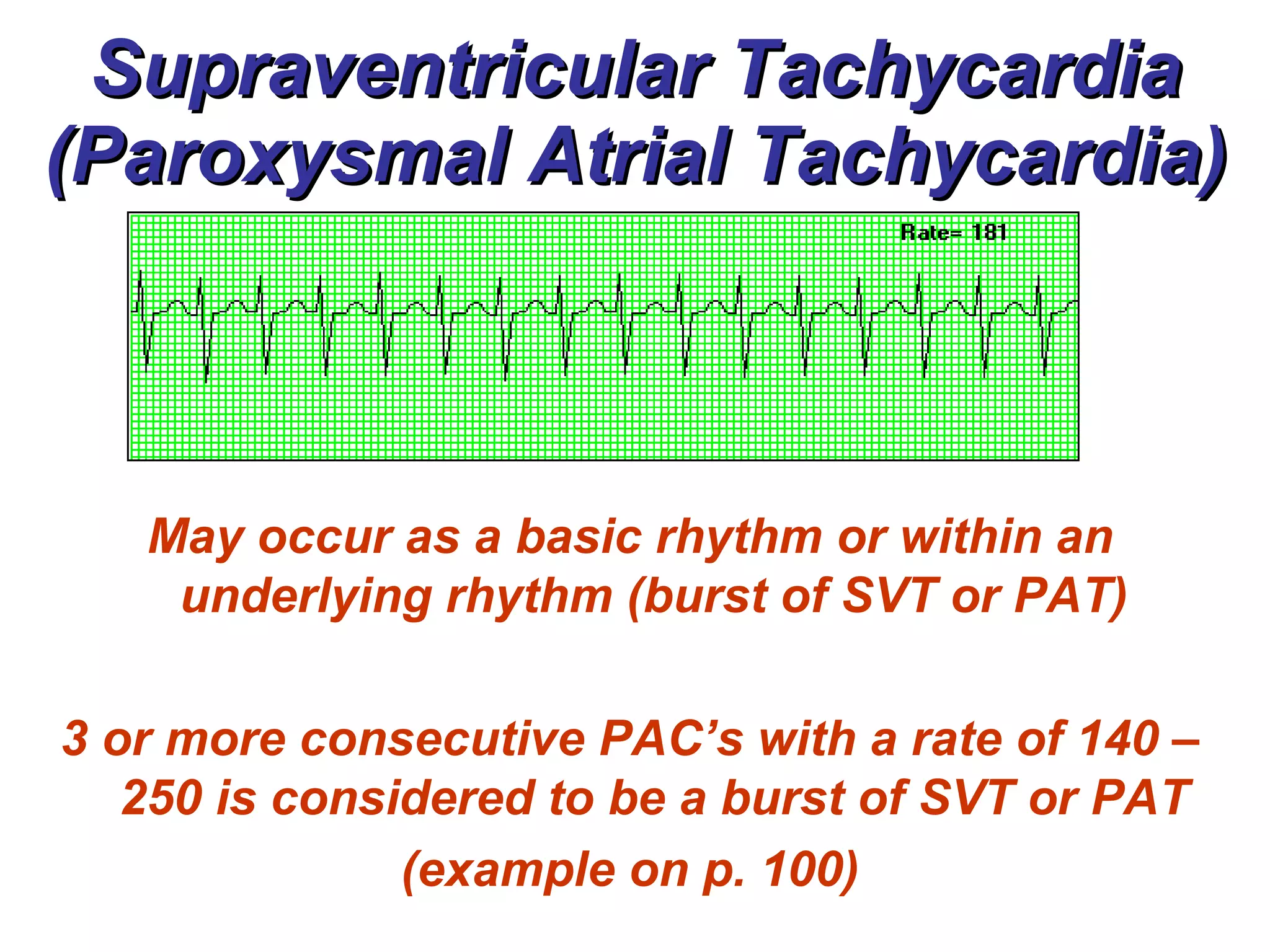 Supraventricular Tachycardia (Paroxysmal Atrial Tachycardia) May occur as a basic rhythm or within an underlying rhythm (burst of SVT or PAT) 3 or more consecutive PAC’s with a rate of 140 – 250 is considered to be a burst of SVT or PAT (example on p. 100) 