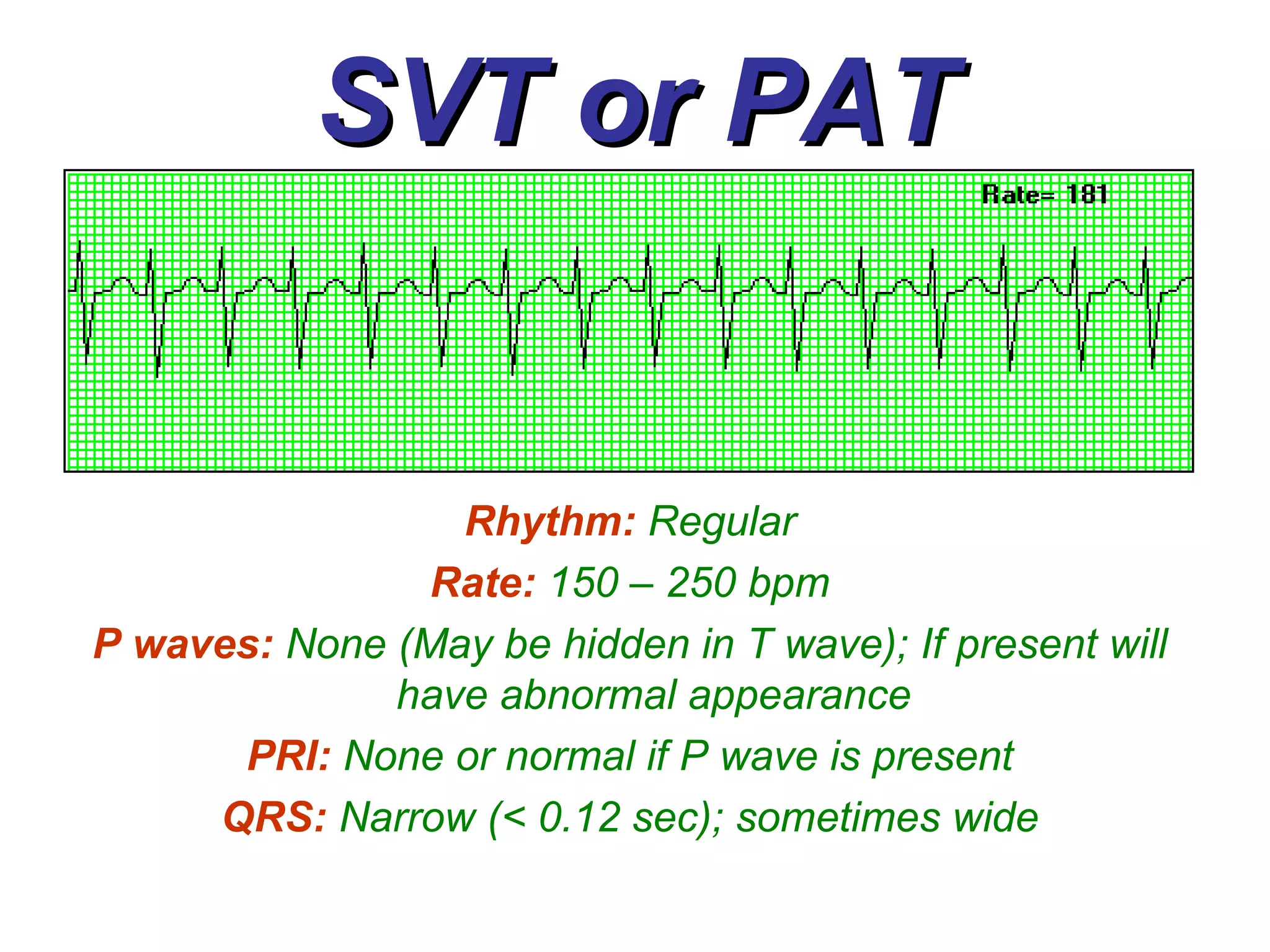 SVT or PAT Rhythm:   Regular Rate:   150 – 250 bpm P waves:   None (May be hidden in T wave); If present will have abnormal appearance PRI:   None or normal if P wave is present QRS:   Narrow (< 0.12 sec); sometimes wide 