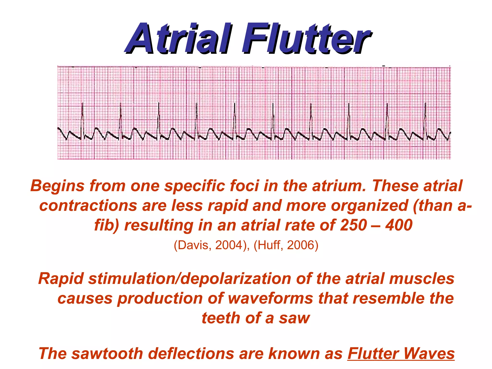 Atrial Flutter Begins from one specific foci in the atrium. These atrial contractions are less rapid and more organized (than a-fib) resulting in an atrial rate of 250 – 400  (Davis, 2004), (Huff, 2006) Rapid stimulation/depolarization of the atrial muscles causes production of waveforms that resemble the teeth of a saw The sawtooth deflections are known as  Flutter Waves 
