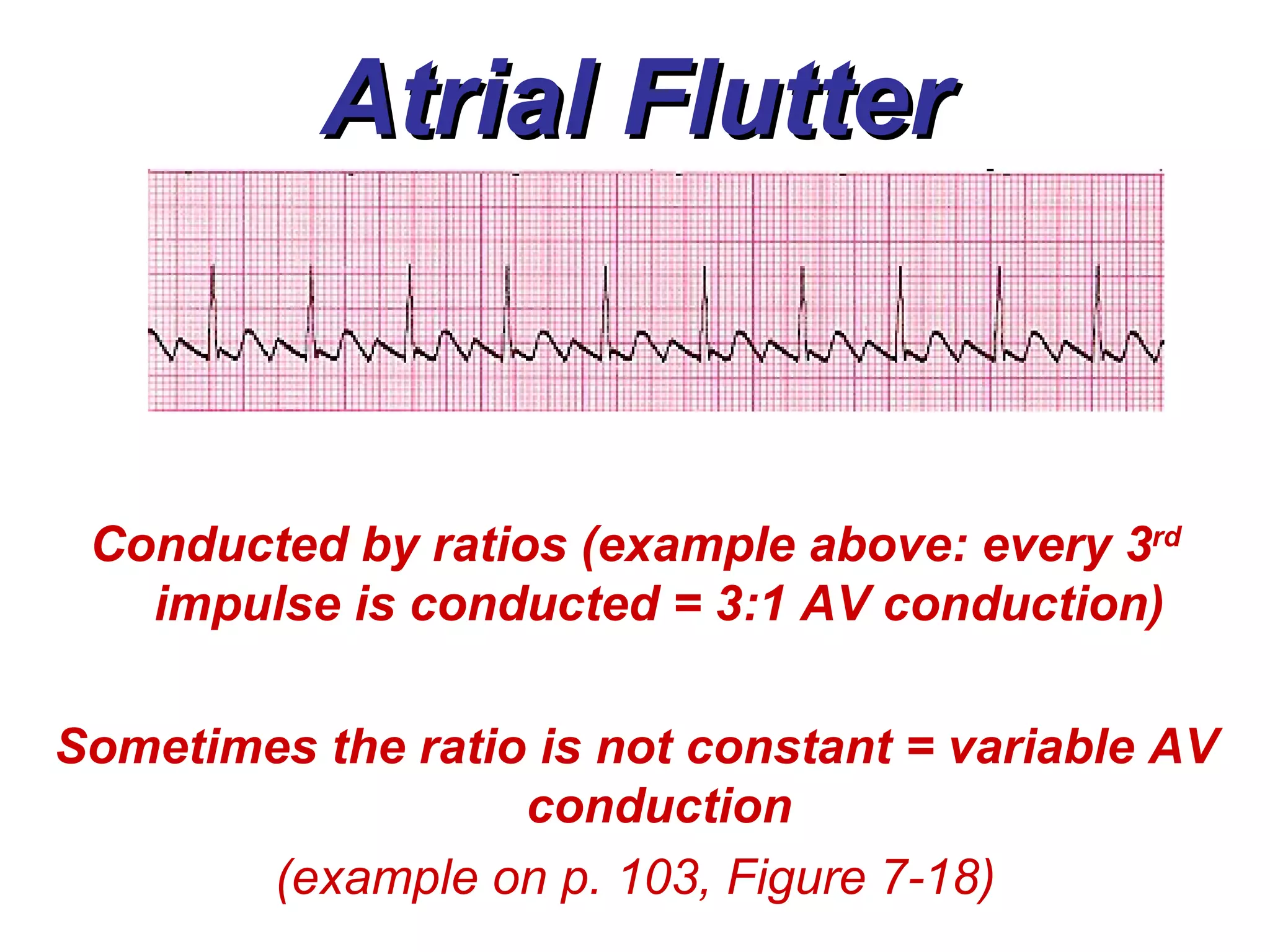Atrial Flutter Conducted by ratios (example above: every 3 rd  impulse is conducted = 3:1 AV conduction) Sometimes the ratio is not constant = variable AV conduction (example on p. 103, Figure 7-18) 