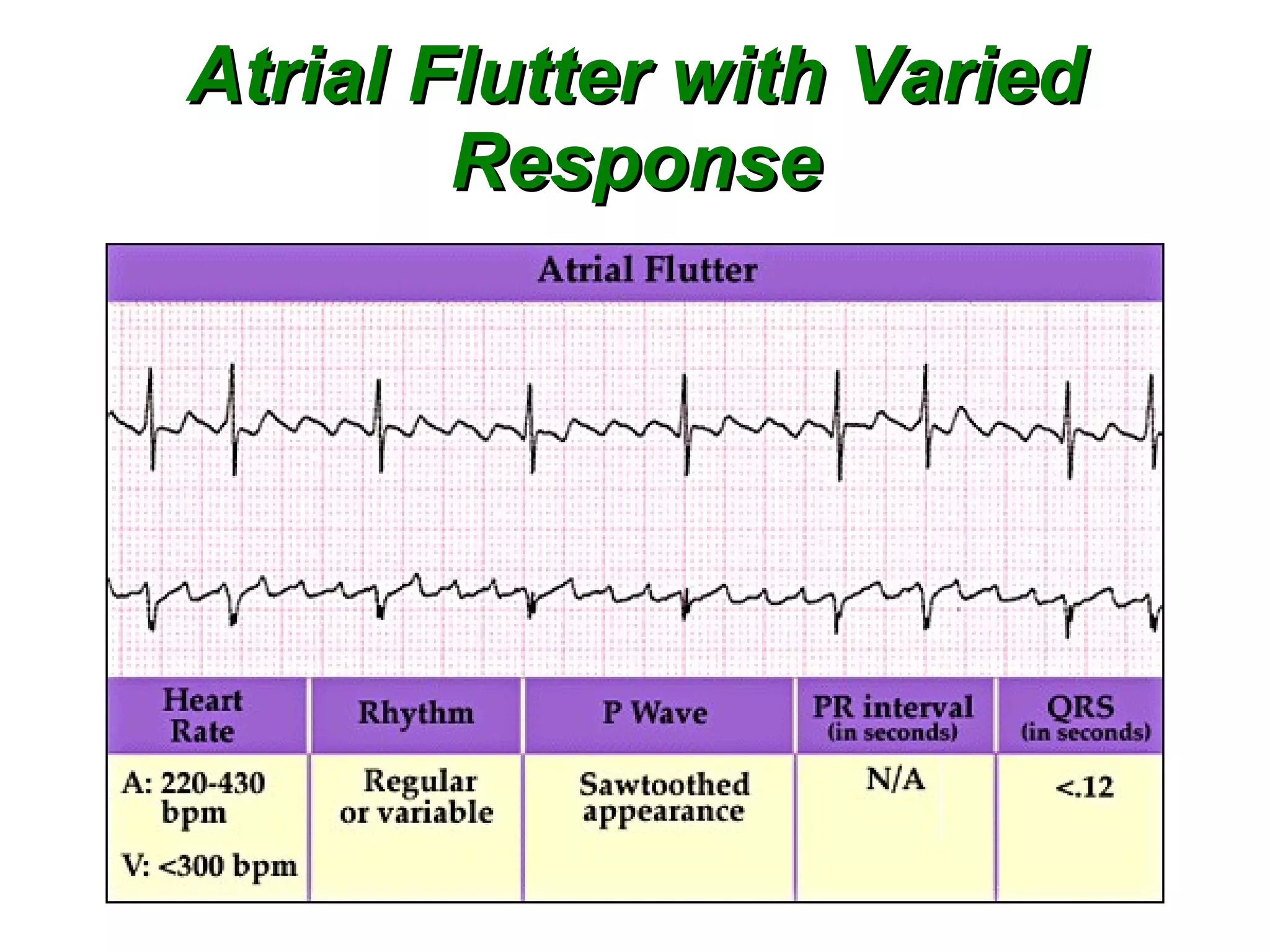 Atrial Flutter with Varied Response 
