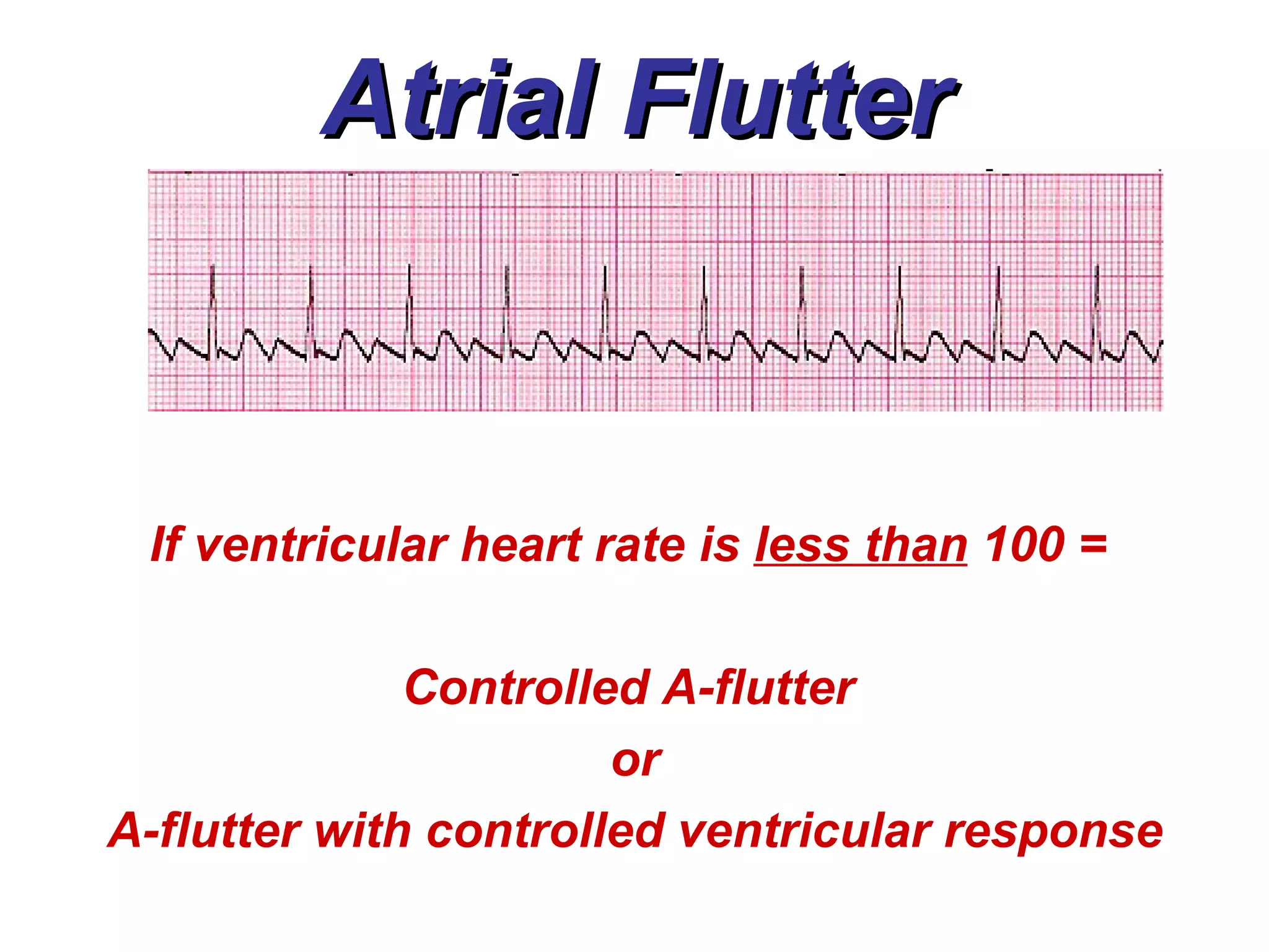 Atrial Flutter If ventricular heart rate is  less than  100 =  Controlled A-flutter  or A-flutter with controlled ventricular response 