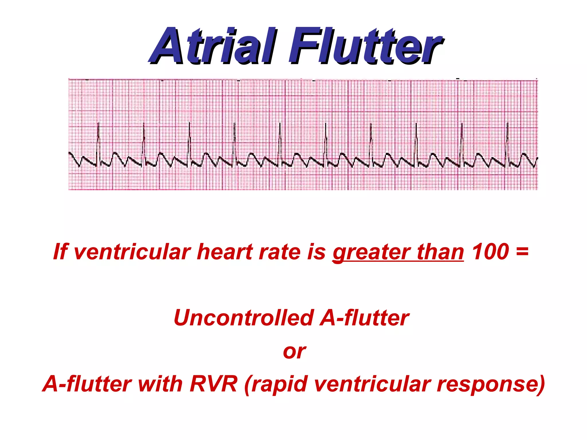 Atrial Flutter If ventricular heart rate is  greater than  100 =  Uncontrolled A-flutter  or A-flutter with RVR (rapid ventricular response) 