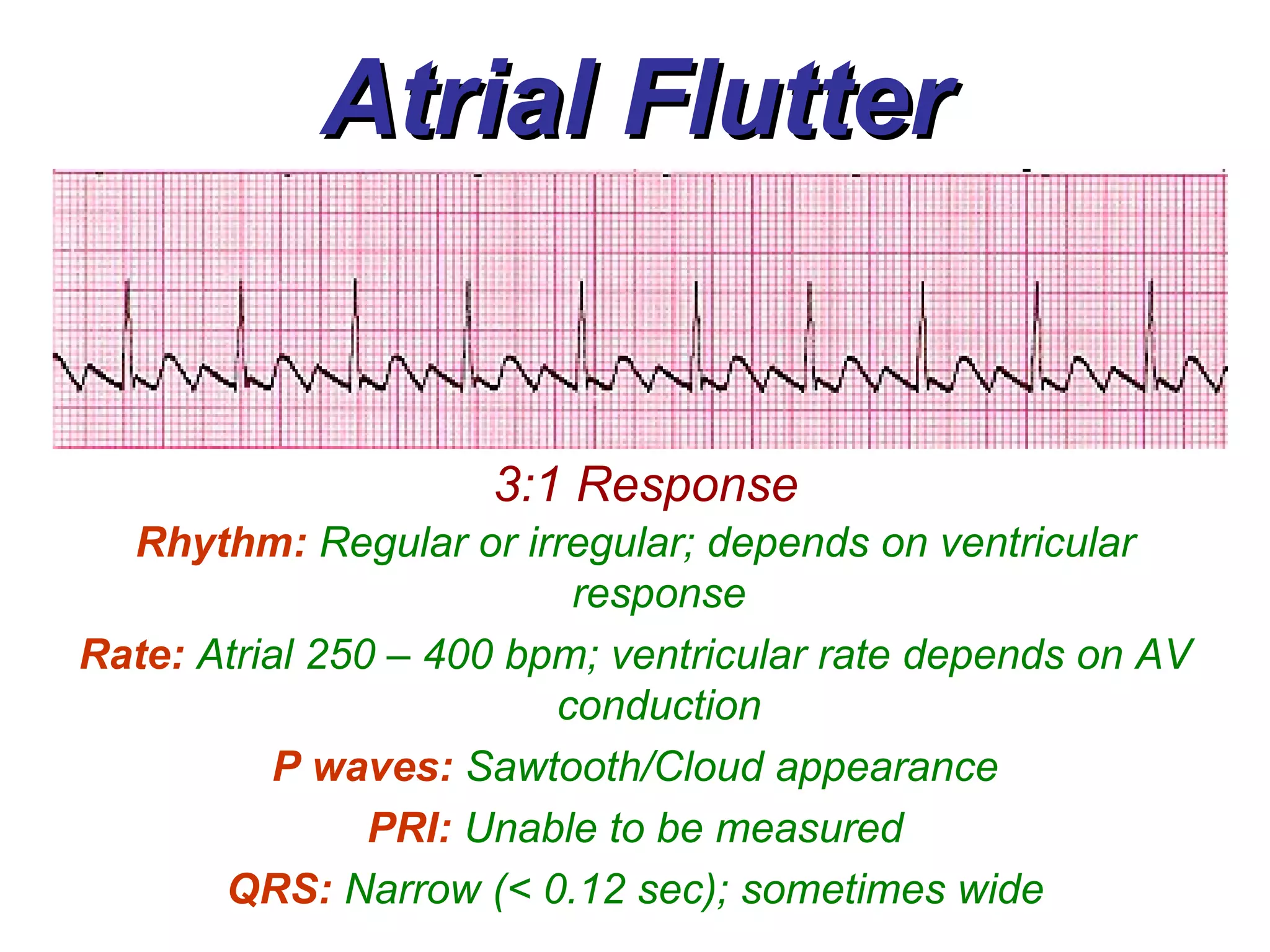 Atrial Flutter 3:1 Response Rhythm:   Regular or irregular; depends on ventricular response Rate:  Atrial 250 – 400 bpm; ventricular rate depends on AV conduction P waves:   Sawtooth/Cloud appearance PRI:   Unable to be measured QRS:   Narrow (< 0.12 sec); sometimes wide 