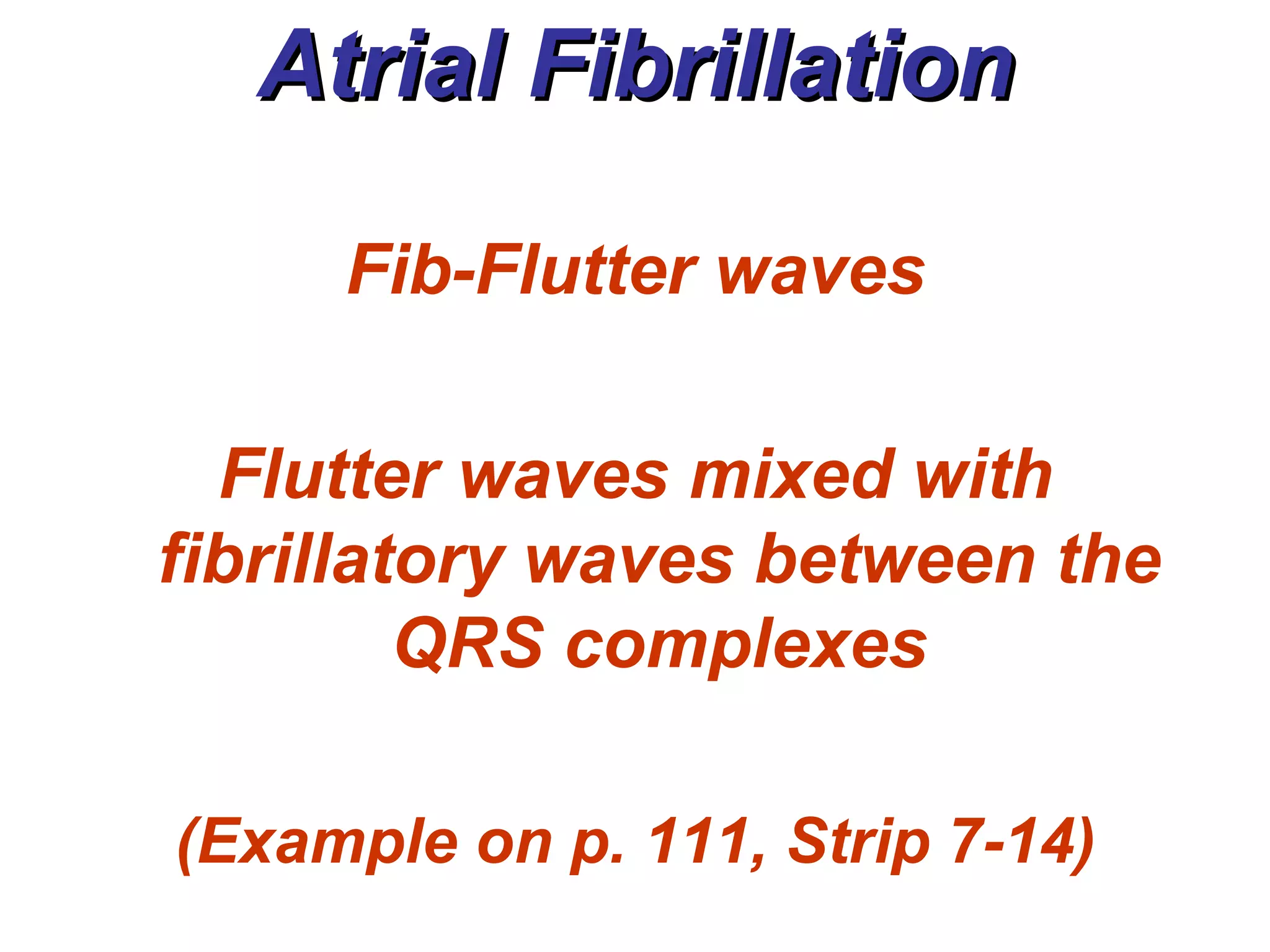 Atrial Fibrillation Fib-Flutter waves Flutter waves mixed with fibrillatory waves between the QRS complexes (Example on p. 111, Strip 7-14) 