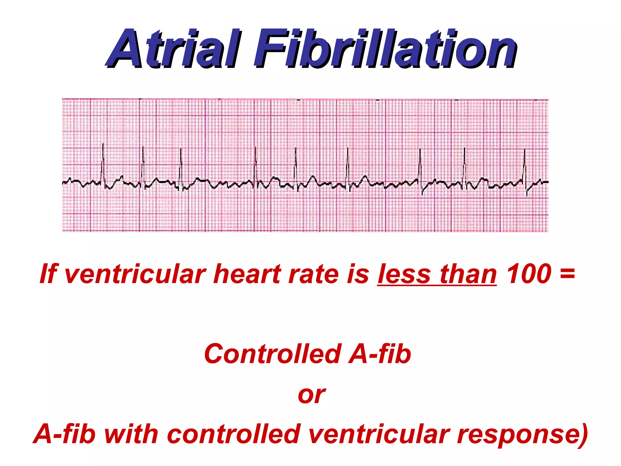 Atrial Fibrillation If ventricular heart rate is  less than  100 =  Controlled A-fib  or A-fib with controlled ventricular response) 