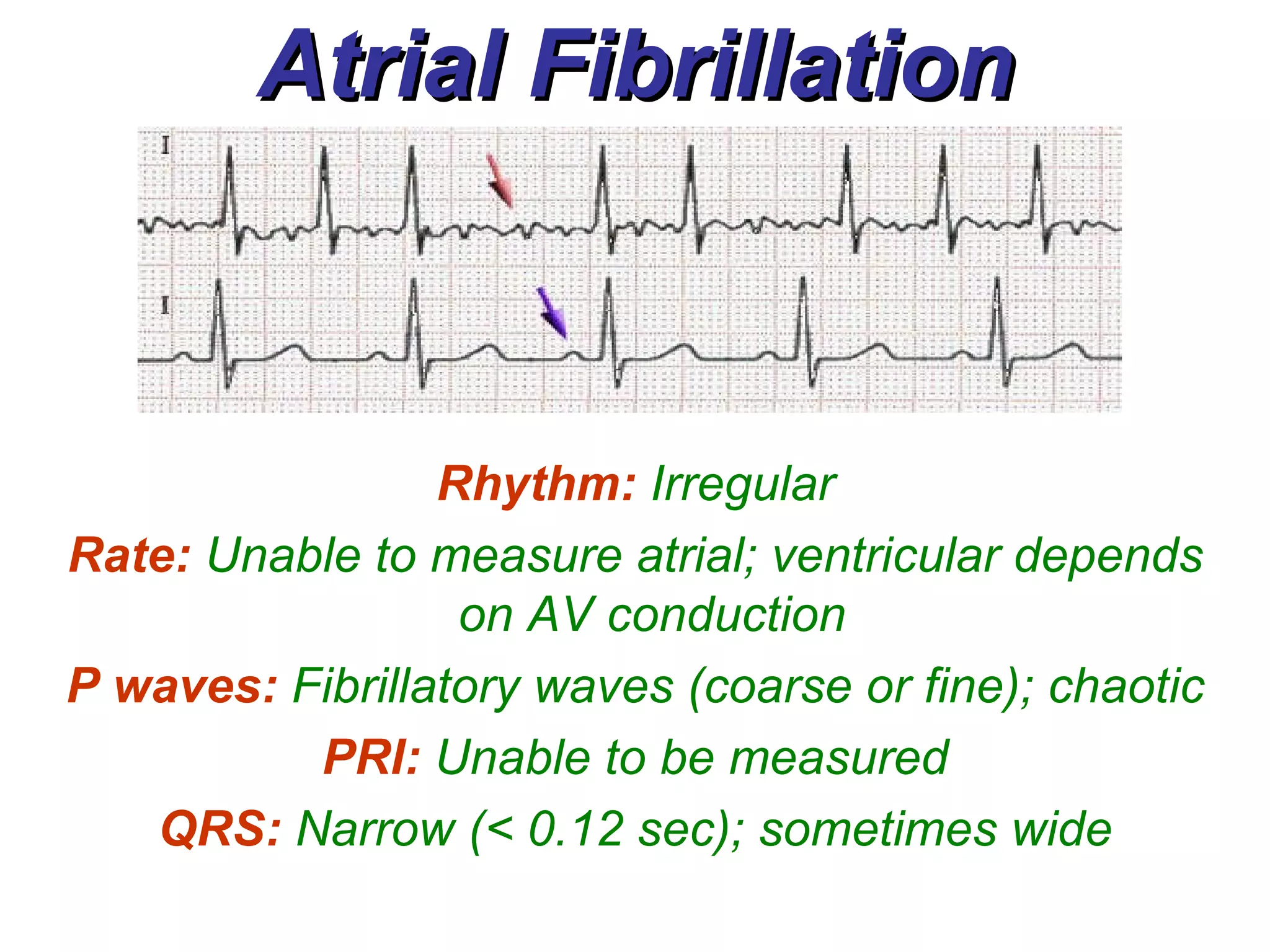 Atrial Fibrillation Rhythm:   Irregular Rate:  Unable to measure atrial; ventricular depends on AV conduction  P waves:   Fibrillatory waves (coarse or fine); chaotic PRI:   Unable to be measured QRS:   Narrow (< 0.12 sec); sometimes wide 