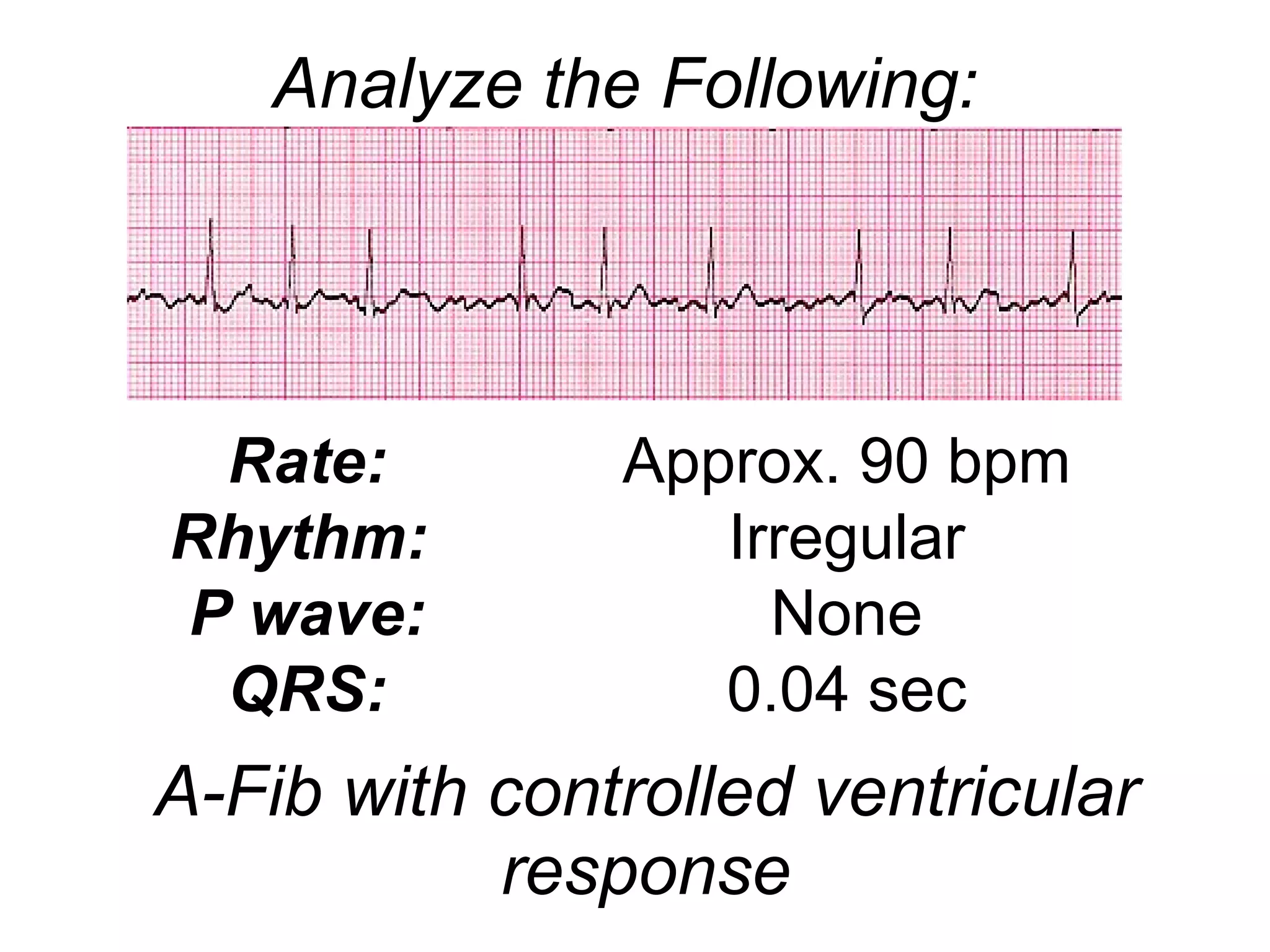 A-Fib with controlled ventricular response Rate: Rhythm:   P wave: QRS: Approx. 90 bpm Irregular None 0.04 sec Analyze the Following: 