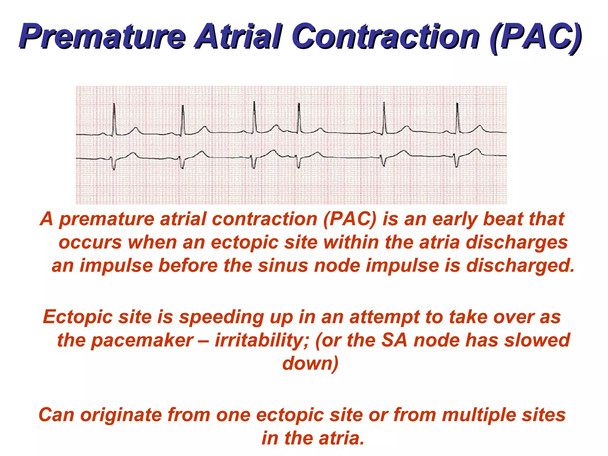 Premature Atrial Contraction (PAC)  A premature atrial contraction (PAC) is an early beat that occurs when an ectopic site within the atria discharges an impulse before the sinus node impulse is discharged.  Ectopic site is speeding up in an attempt to take over as the pacemaker – irritability; (or the SA node has slowed down)  Can originate from one ectopic site or from multiple sites in the atria. 