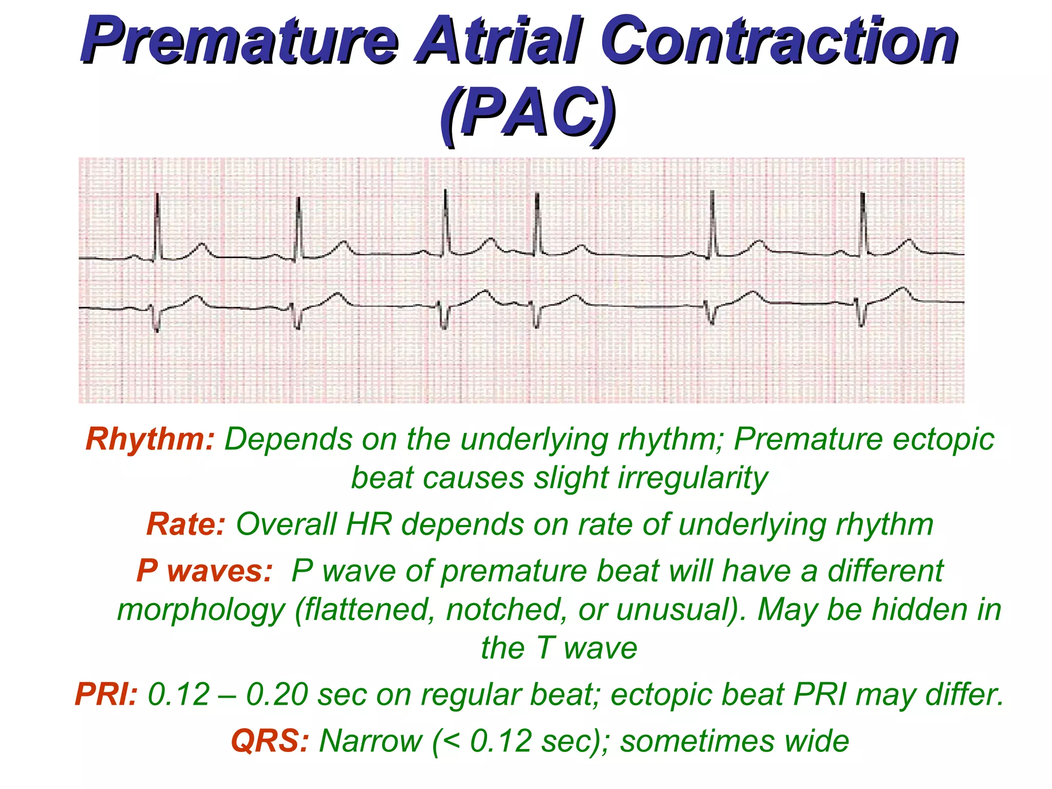 Premature Atrial Contraction  (PAC) Rhythm:   Depends on the underlying rhythm; Premature ectopic beat causes slight irregularity Rate:  Overall HR depends on rate of underlying rhythm P waves:  P wave of premature beat will have a different morphology (flattened, notched, or unusual). May be hidden in the T wave PRI:  0.12 – 0.20 sec on regular beat; ectopic beat PRI may differ. QRS:  Narrow (< 0.12 sec); sometimes wide 