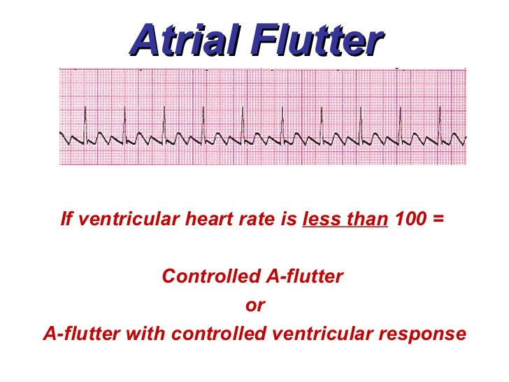 3a atrial rhythms