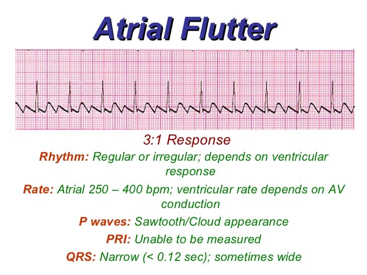 Flatter means. Atrial Flutter ECG. Atrial Fibrillation ECG Criteria. Ventricular Flutter ECG. Atrial tachycardia ECG.
