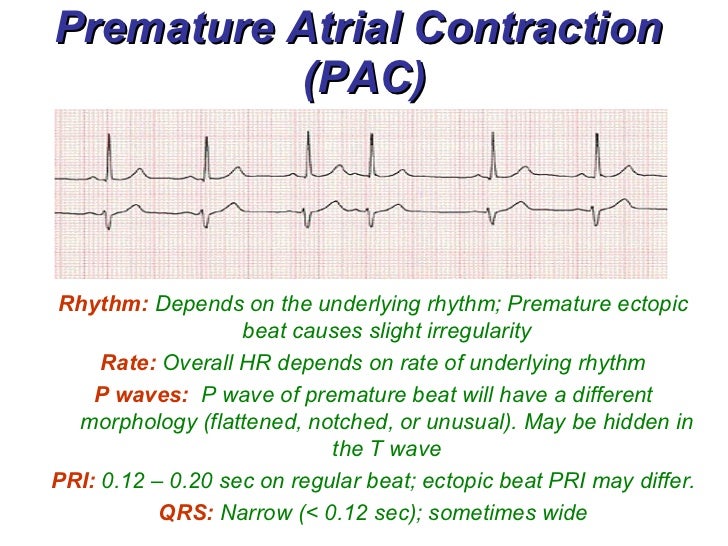 3a atrial rhythms