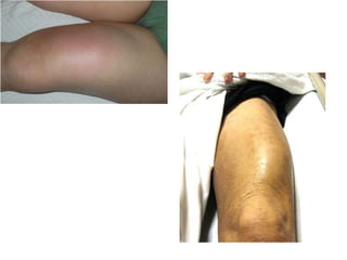 3) ABSCESS.pptx