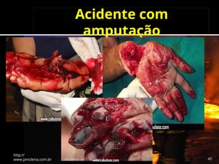 Acidente com
amputação
http://
www.janicleria.com.br Acidente de Trabalho 45
 