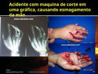 Acidente com maquina de corte em
uma gráfica, causando esmagamento
da mão
http://
www.janicleria.com.br Acidente de Trabalho 46
 