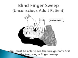 You must be able to see the foreign body first
before using a finger sweep.
 