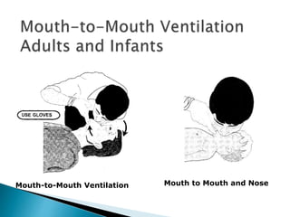 Mouth-to-Mouth Ventilation Mouth to Mouth and Nose
 