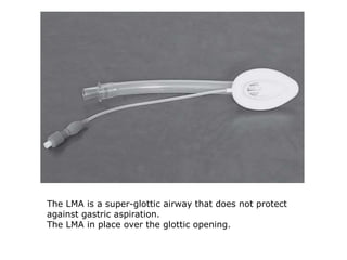 The LMA is a super-glottic airway that does not protect
against gastric aspiration.
The LMA in place over the glottic opening.
 