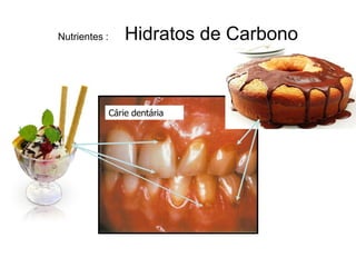 Nutrientes :       Hidratos de Carbono



               Cárie dentária
 