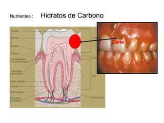Nutrientes :   Hidratos de Carbono


                                     Cárie
 