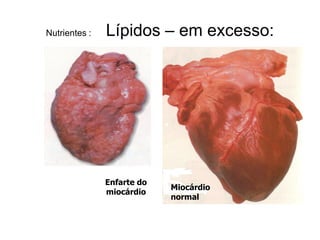 Nutrientes :   Lípidos – em excesso:




               Enfarte do
                            Miocárdio
               miocárdio
                            normal
 