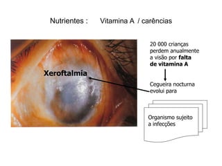 Nutrientes :   Vitamina A / carências


                               20 000 crianças
                               perdem anualmente
                               a visão por falta
                               de vitamina A
Xeroftalmia
                               Cegueira nocturna
                               evolui para



                              Organismo sujeito
                              a infecções
 