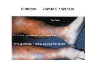 Nutrientes :       Vitamina B1 / carências


                                   Beribéri




Forma seca: paralisia dos membros inferiores


Forma edematosa: + grave; evolução mais rápida
 
