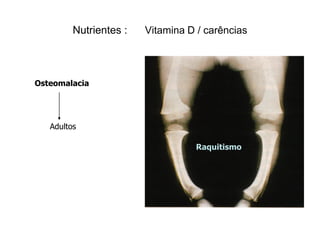 Nutrientes :   Vitamina D / carências




Osteomalacia




   Adultos

                                  Raquitismo
 