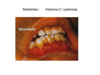 Nutrientes :   Vitamina C / carências




Escorbuto
 