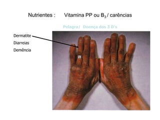 Nutrientes :   Vitamina PP ou B3 / carências

                       Pelagra/ Doença dos 3 D’s

Dermatite
Diarreias
Demência
 
