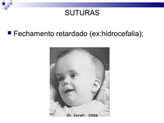 SUTURAS
 Fechamento retardado (ex:hidrocefalia);
 