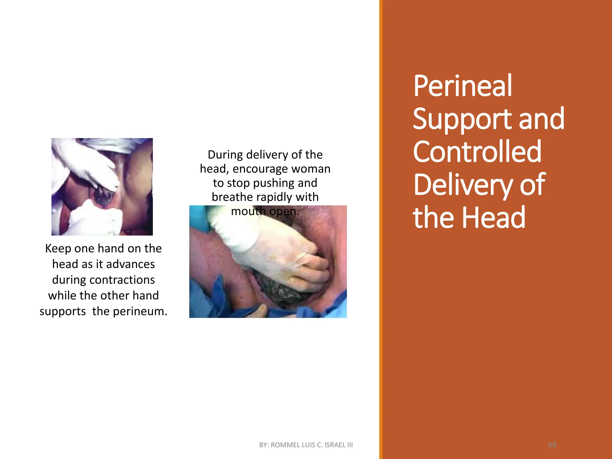 Perineal
Support and
Controlled
Delivery of
the Head
Keep one hand on the
head as it advances
during contractions
while the other hand
supports the perineum.
During delivery of the
head, encourage woman
to stop pushing and
breathe rapidly with
mouth open.
BY: ROMMEL LUIS C. ISRAEL III 49
 