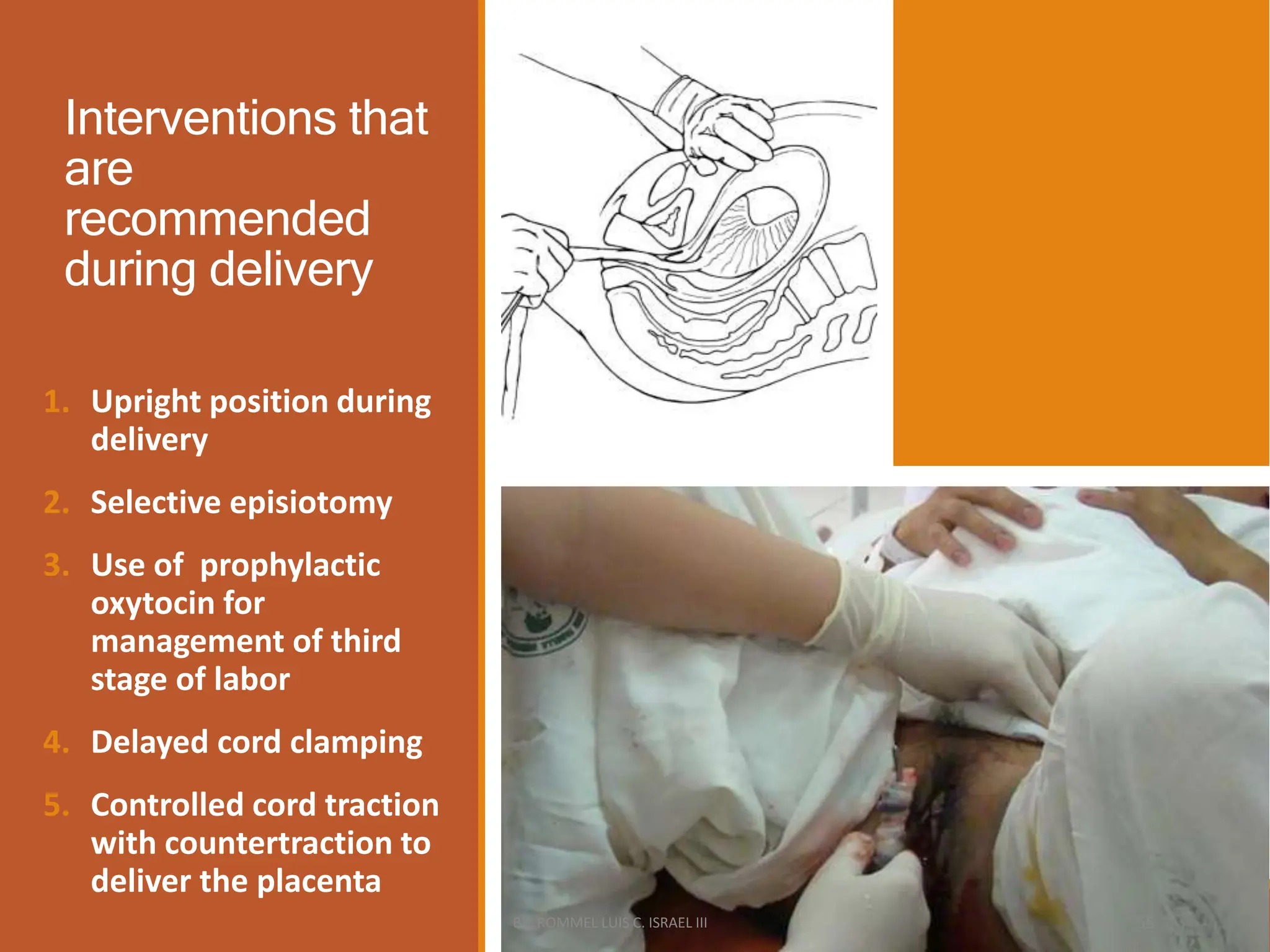 Interventions that
are
recommended
during delivery
1. Upright position during
delivery
2. Selective episiotomy
3. Use of prophylactic
oxytocin for
management of third
stage of labor
4. Delayed cord clamping
5. Controlled cord traction
with countertraction to
deliver the placenta
BY: ROMMEL LUIS C. ISRAEL III 55
 