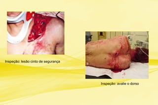 Inspeção: lesão cinto de segurança
Inspeção: avalie o dorso
 